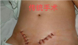 24小時(shí)出院！欽州市第二人民醫(yī)院日間手術(shù)為小兒腹股溝斜疝患者解憂愁