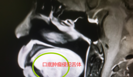 【欽二醫(yī)技術(shù)】口底癌侵犯舌體并頸淋巴結(jié)轉(zhuǎn)移，專家妙手成功再造舌體
