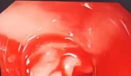 【欽二醫(yī)技術】凌晨，一場驚心動魄的消化道大出血患者搶救接力賽上演