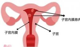 【欽二醫(yī)生說】小小子宮內(nèi)膜息肉 除了引起出血還可導(dǎo)致“不孕”